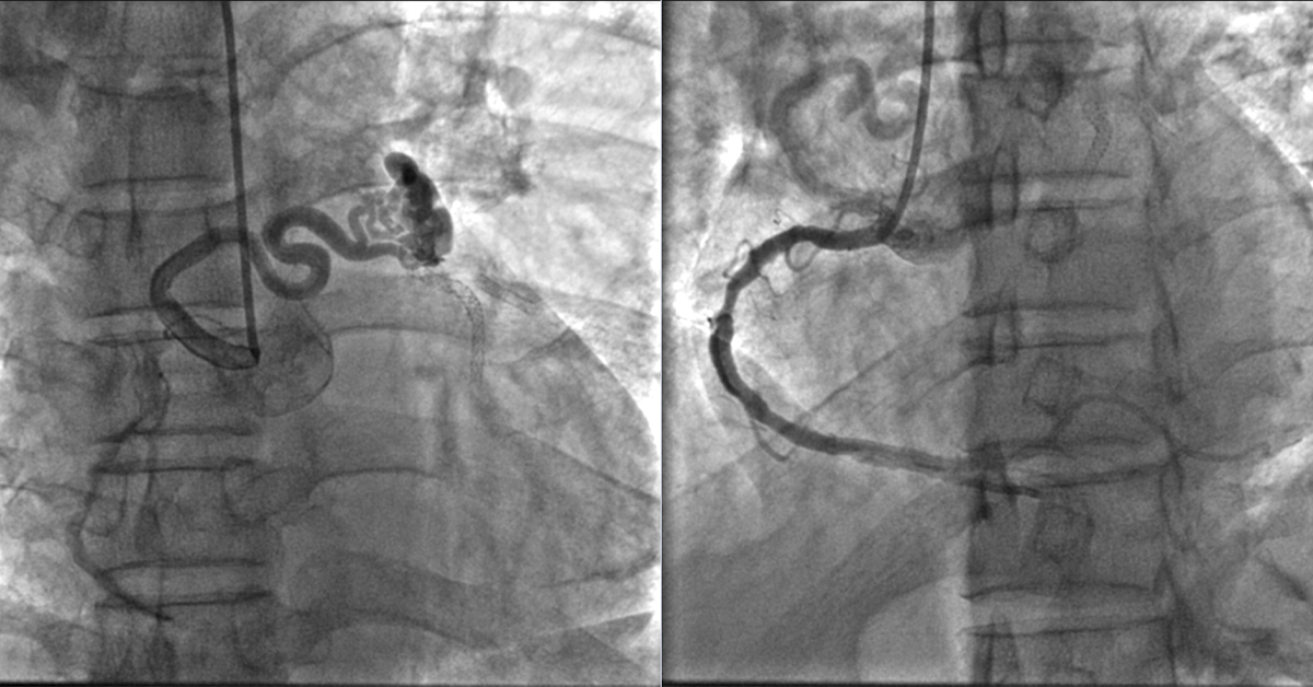 AV Fistula for Dialysis Forrest City Medical Center